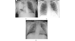 Figure 1: Example posteroanterior chest radiography images of: (a) bacterial infection, (b) non-COVID19 viral infection, and (c) COVID-19 viral infection in COVIDx dataset.