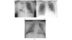 Figure 1: Example posteroanterior chest radiography images of: (a) bacterial infection, (b) non-COVID19 viral infection, and (c) COVID-19 viral infection in COVIDx dataset.