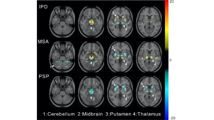 Credit: Images created by Ping Wu and Yu Zhao, et al., Huashan Hospital, Fudan University In Shanghai, China And University Of Bern In Bern, Switzerland.