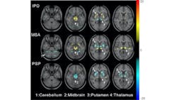 Credit: Images created by Ping Wu and Yu Zhao, et al., Huashan Hospital, Fudan University In Shanghai, China And University Of Bern In Bern, Switzerland. Credit: Images created by Ping Wu and Yu Zhao, et al., Huashan Hospital, Fudan University In Shanghai, China And University Of Bern In Bern, Switzerland.