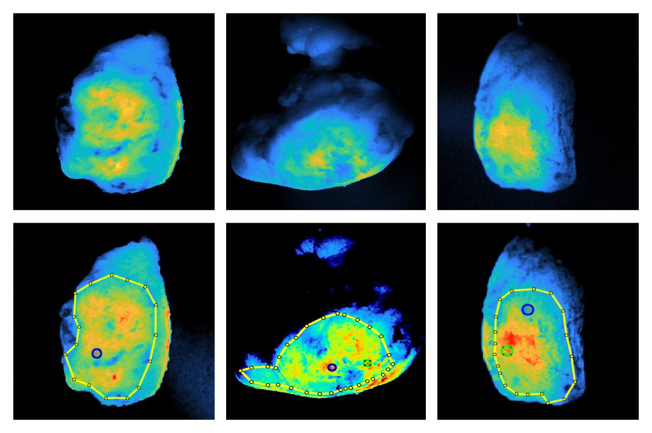 Scans of tumors using fluorescent molecules that preferentially bind to cancer. Drawn boundaries mark regions of interest defined by surgeons, and the locations indicated mark spots where cancer is closest to the surface