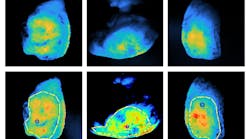 Scans of tumors using fluorescent molecules that preferentially bind to cancer. Drawn boundaries mark regions of interest defined by surgeons, and the locations indicated mark spots where cancer is closest to the surface Scans of tumors using fluorescent molecules that preferentially bind to cancer. Drawn boundaries mark regions of interest defined by surgeons, and the locations indicated mark spots where cancer is closest to the surface