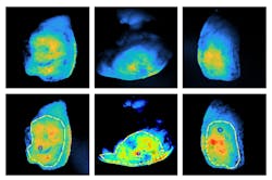 Scans of tumors using fluorescent molecules that preferentially bind to cancer. Drawn boundaries mark regions of interest defined by surgeons, and the locations indicated mark spots where cancer is closest to the surface Scans of tumors using fluorescent molecules that preferentially bind to cancer. Drawn boundaries mark regions of interest defined by surgeons, and the locations indicated mark spots where cancer is closest to the surface