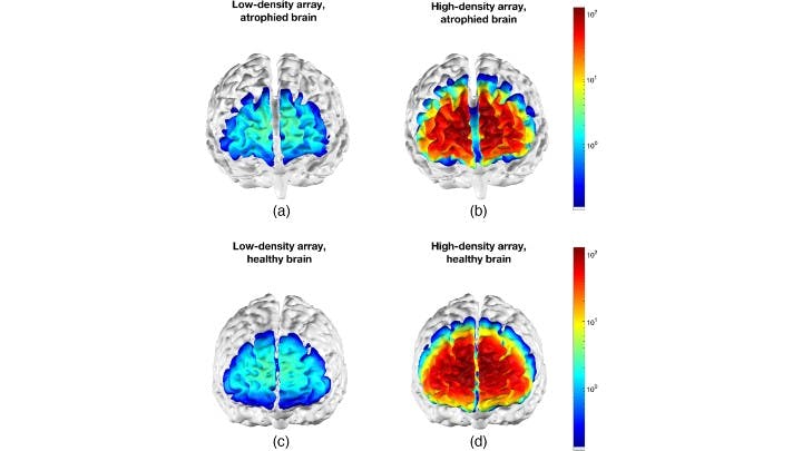 Figure 3: Examples of cortical sensitivity of low-density (a, c) and high-density (b, d) array NIR spectroscopy on a brain with severe atrophy due to Alzheimer&rsquo;s disease (a, b) and a healthy brain (c, d).
