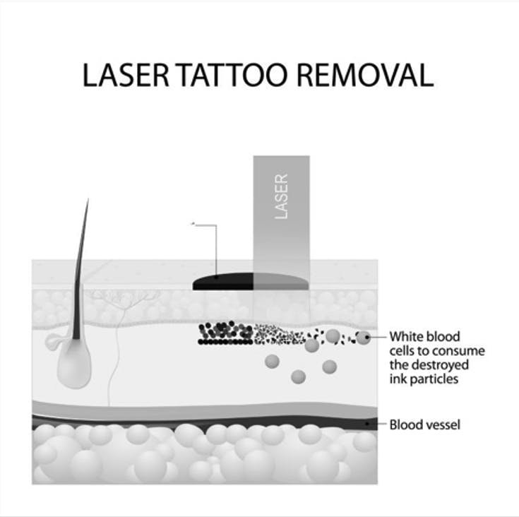 One application of laser optics for skin care is breaking up ink particles for tattoo removal.