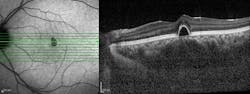 optical coherence tomography (OCT) scan optical coherence tomography (OCT) scan