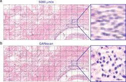 Two-panel comparison of a stitched breast-biopsy tissue mosaic acquired at 5,000 micrometers per second before and after GANscan restoration, with zoomed regions showing blurred nuclei becoming sharper.